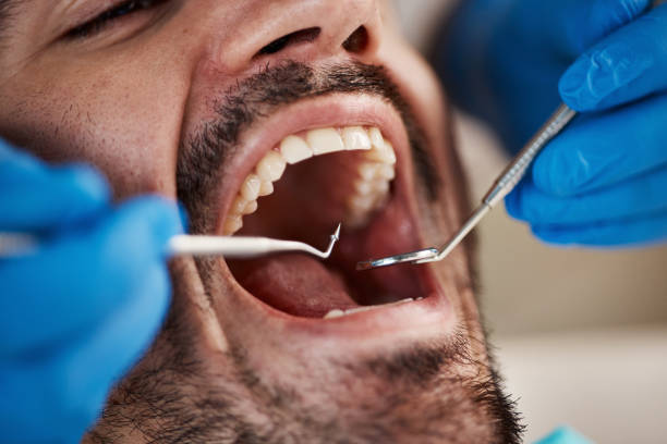 Best Emergency Tooth Extraction in Bruce, MS